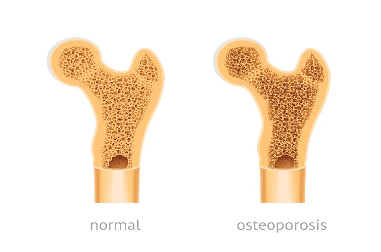 Preventing Osteoporosis through Proper Nutrition: Building Strong Bones for Life