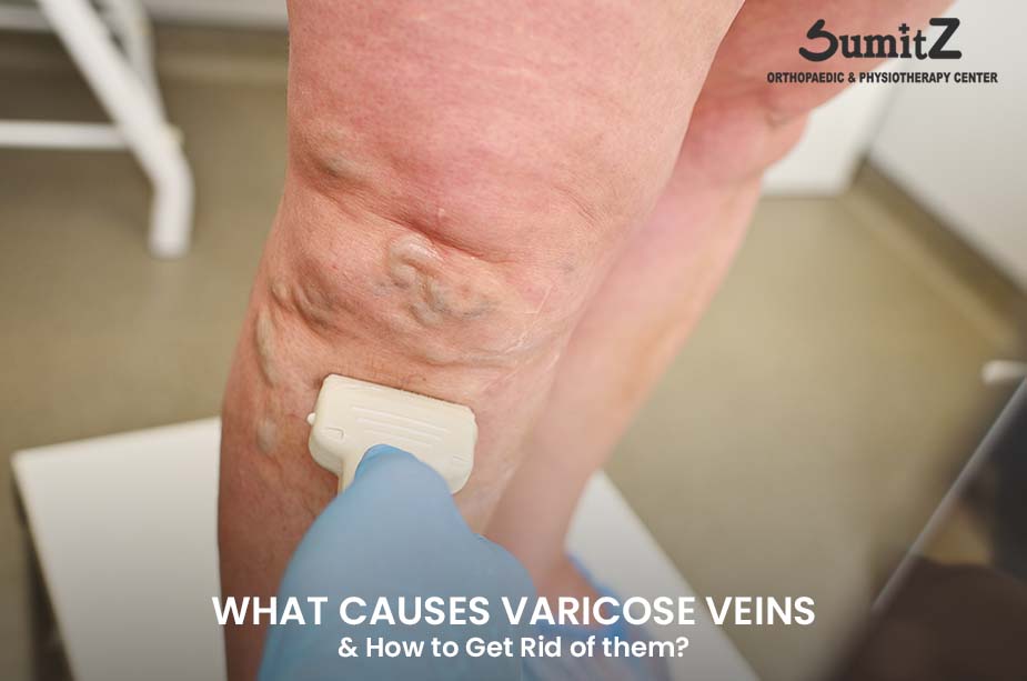What Causes Varicose Veins & How to Get Rid of them?
