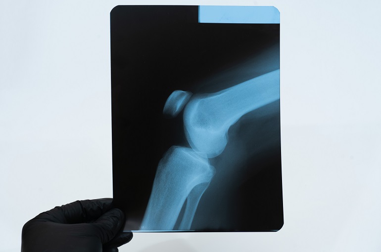 The Importance of X-Rays for Knee and Leg Injuries 