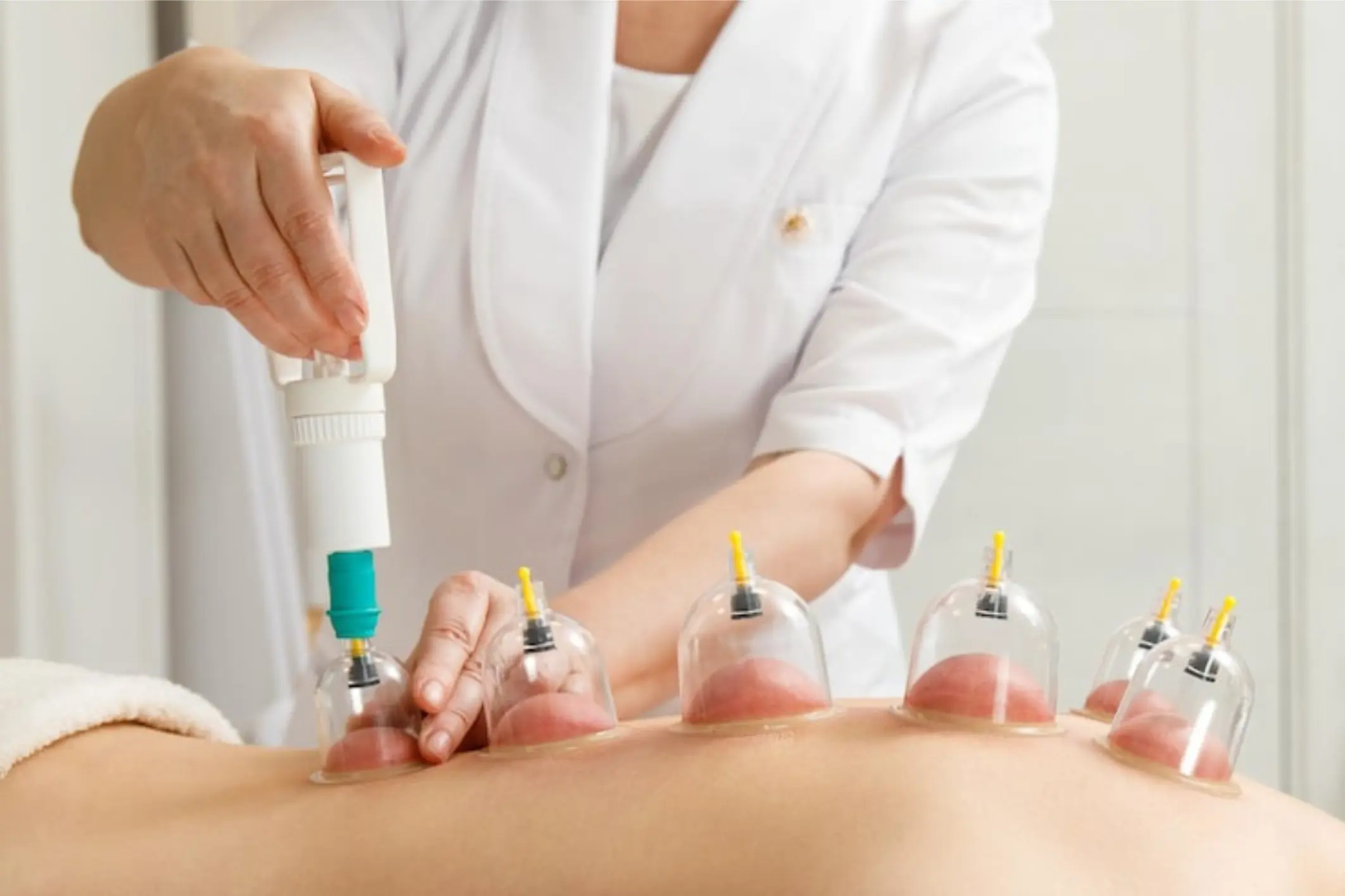 Cupping Therapy in Baner, Balewadi & Pune: Benefits, Blood Circulation & Fire Cup Treatment Explained