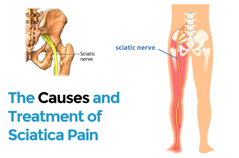 The Causes and Treatment of Sciatica Pain
