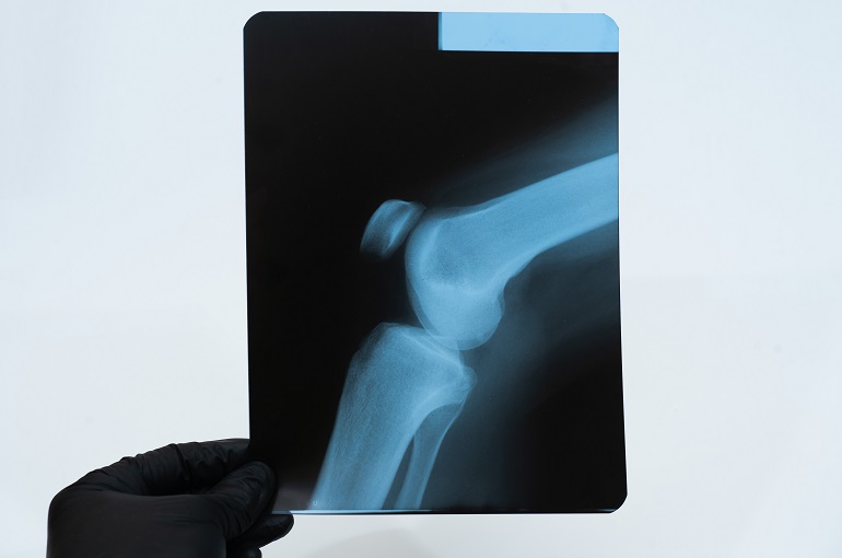 The Importance of X-Rays for Knee and Leg Injuries